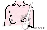 乳房再建術・ｴｷｽﾊﾟﾝﾀﾞｰ挿入.JPG